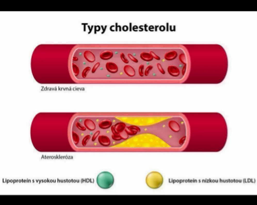 Ako znížiť cholesterol?