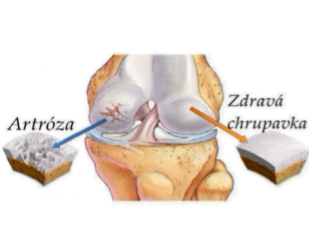Artróza, choroba kĺbov - Ako jej predísť alebo sa jej zbaviť pomocou prírody